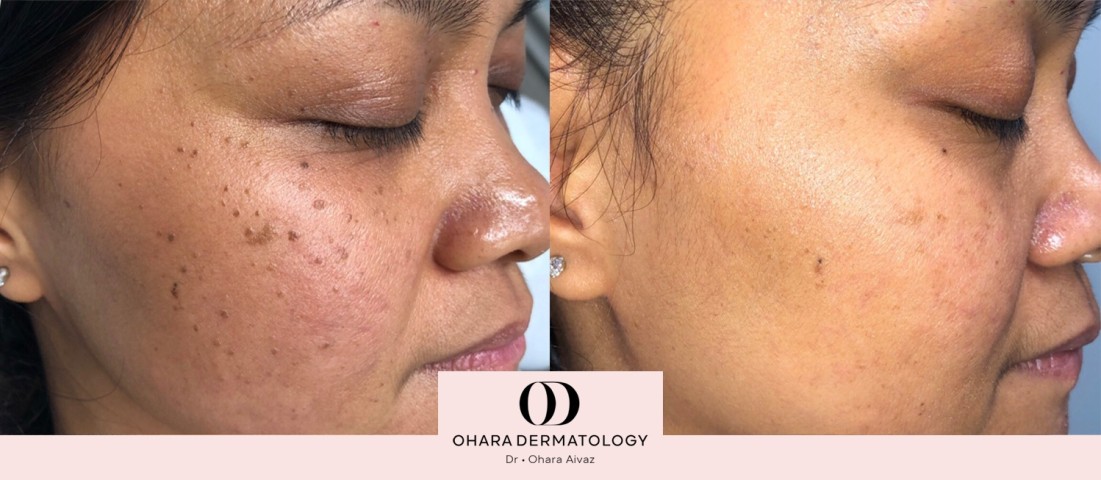 Benign growth and blood vessel removal before and after