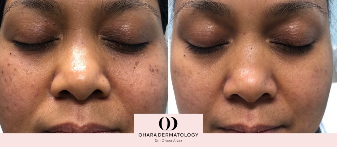 Benign growth and blood vessel removal before and after