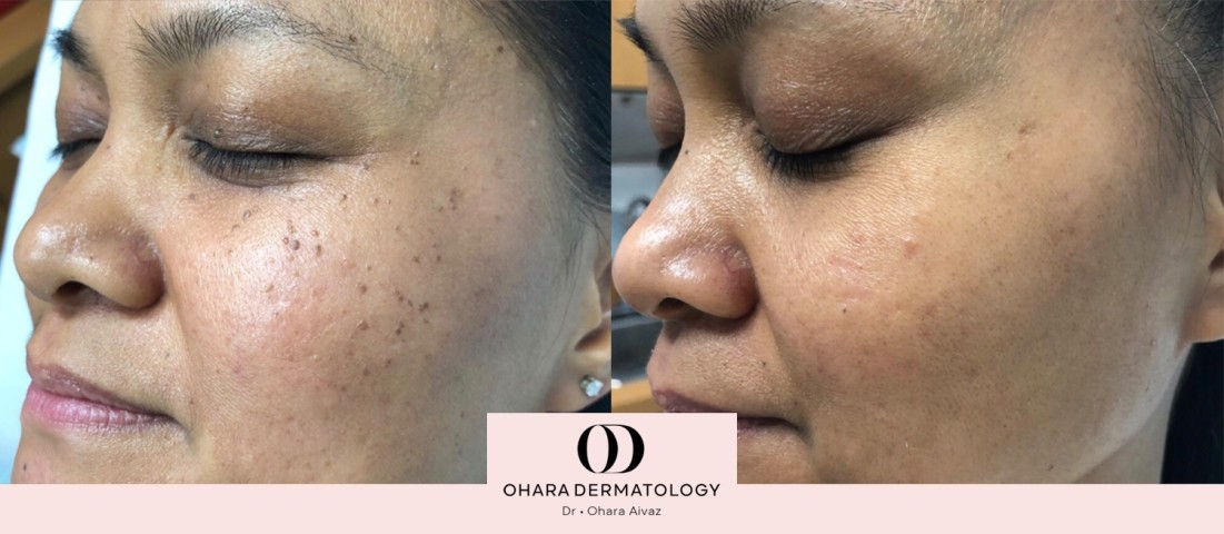 Benign growth and blood vessel removal before and after