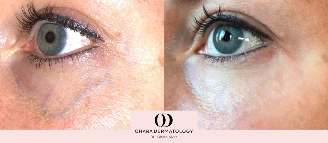 Benign growth and blood vessel removal before and after