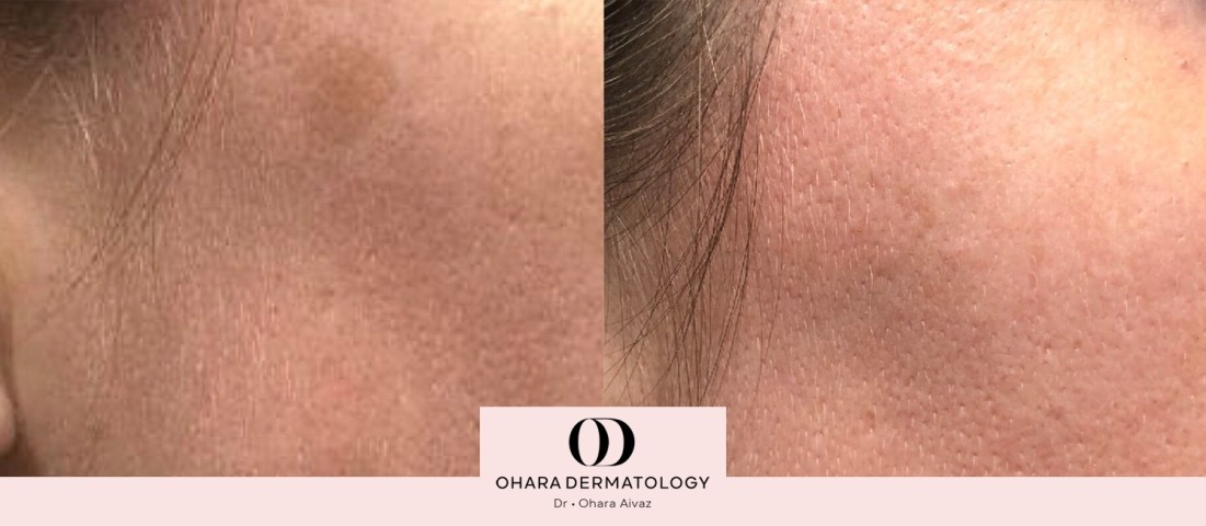 Benign growth and blood vessel removal before and after