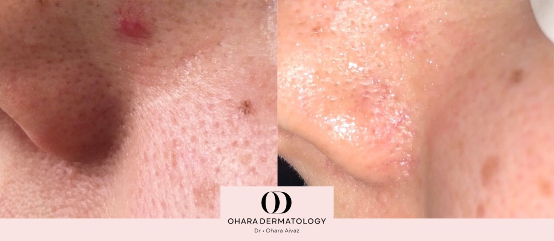 Benign growth and blood vessel removal before and after