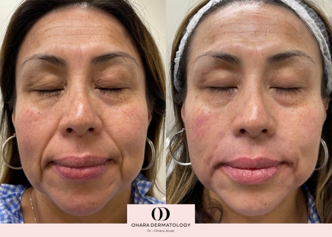 Full face rejuvenation with filler