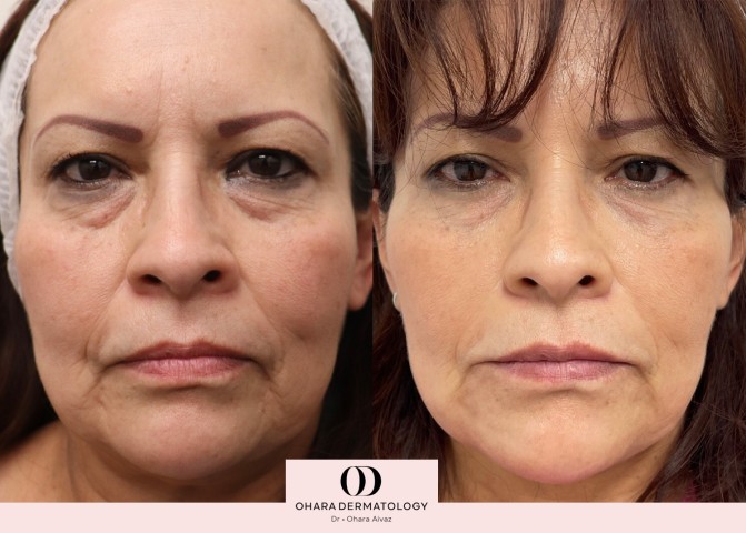 Full face rejuvenation with filler