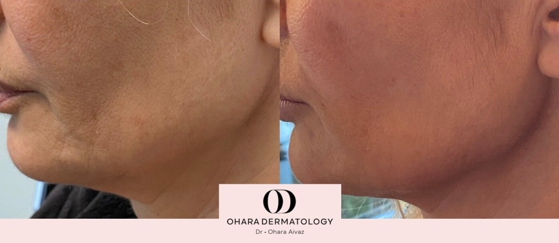 Jawline rejuvenation