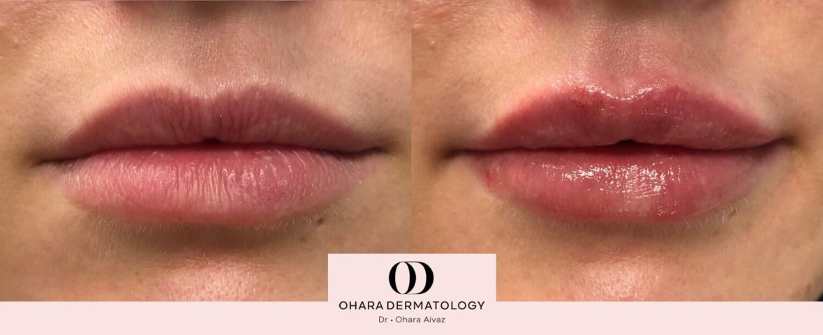 Before and After Lip filler patient 12