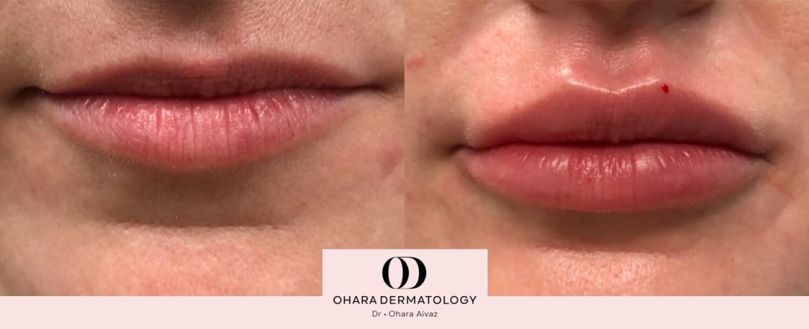 Lip filler patient 2