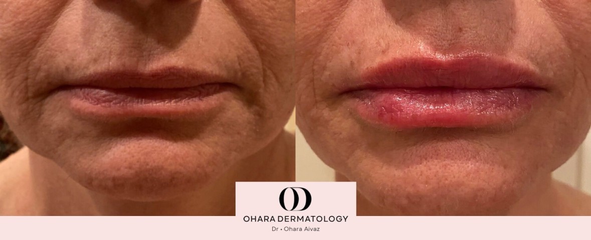 Lip filler patient 3