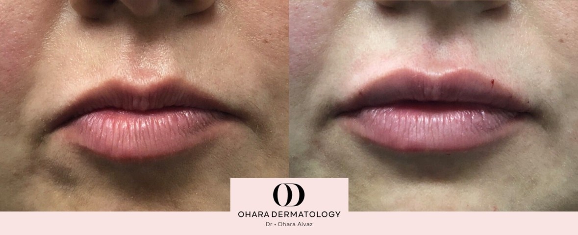 Lip filler patient 5