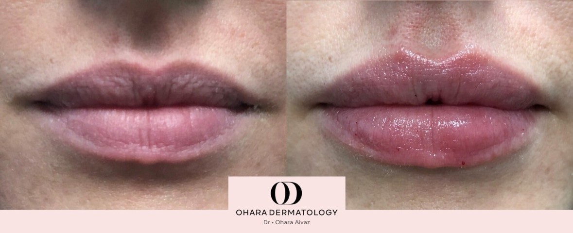 Lip filler patient 7