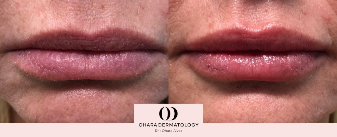 Lip filler patient 8