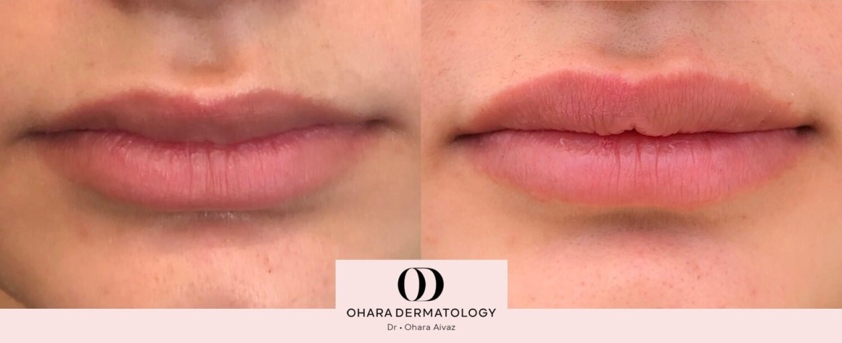 Before and After Lip filler patient 9