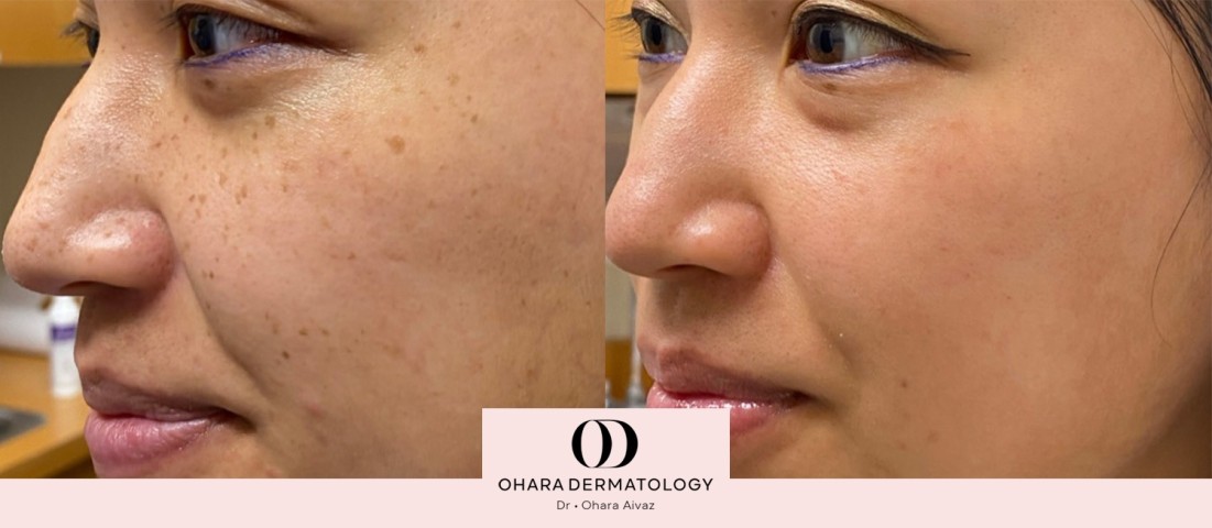 Pigmentation and freckle removal