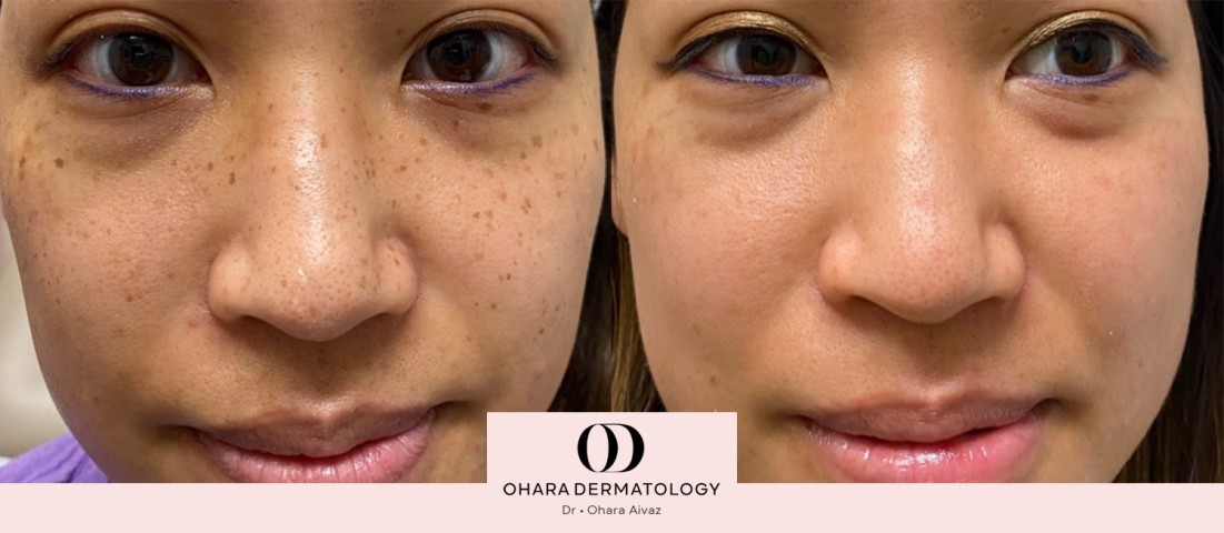 Pigmentation and freckle removal