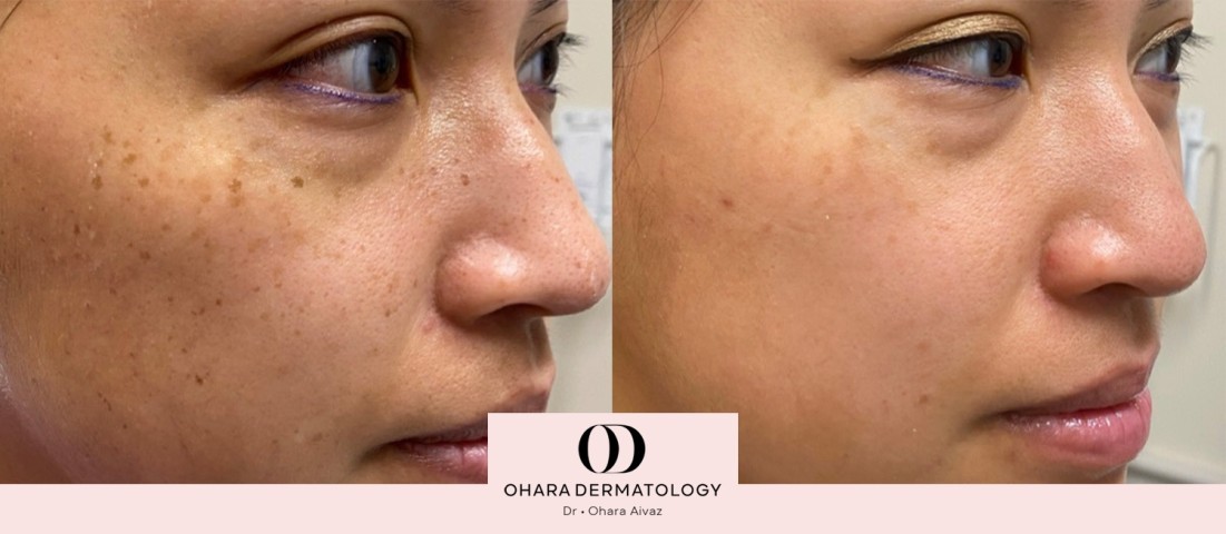Pigmentation and freckle removal