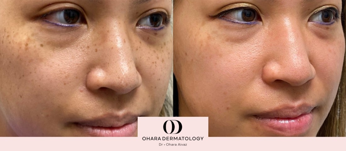 Pigmentation and freckle removal