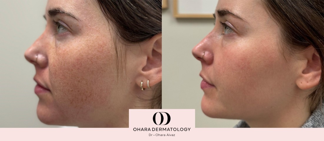 Pigmentation and freckle removal