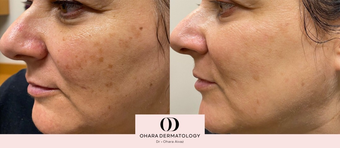 Pigmentation and freckle removal