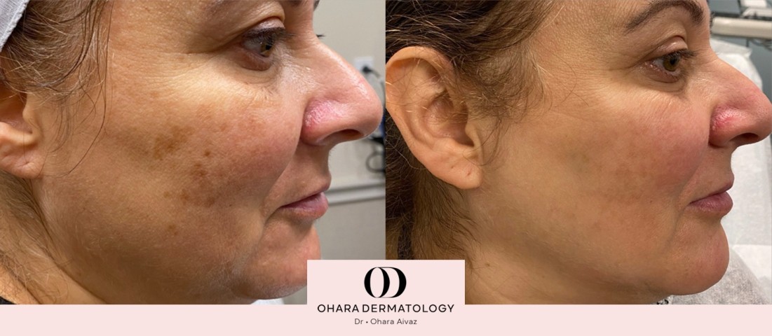 Pigmentation and freckle removal