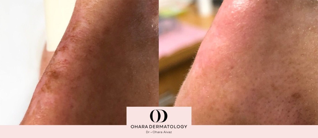 Pigmentation and freckle removal