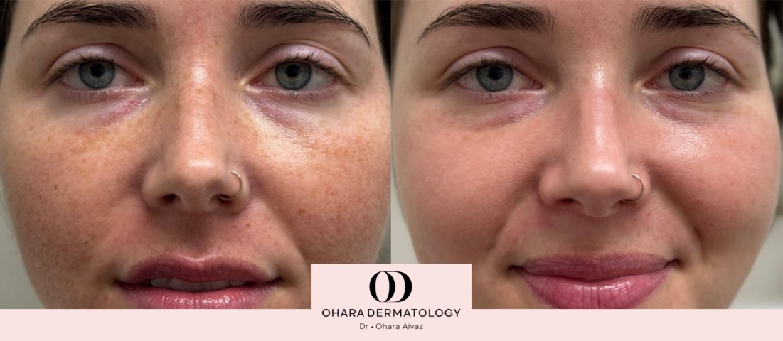 Pigmentation and freckle removal