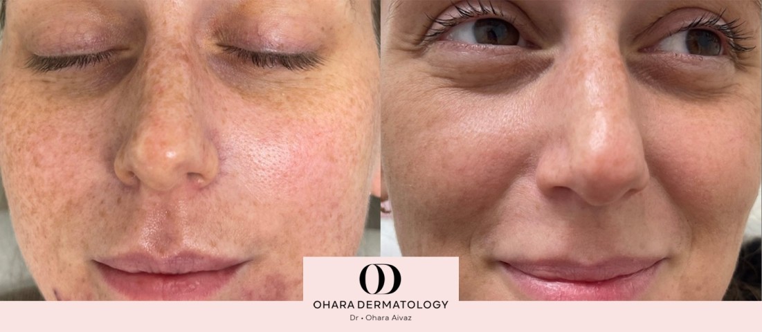 Pigmentation and freckle removal