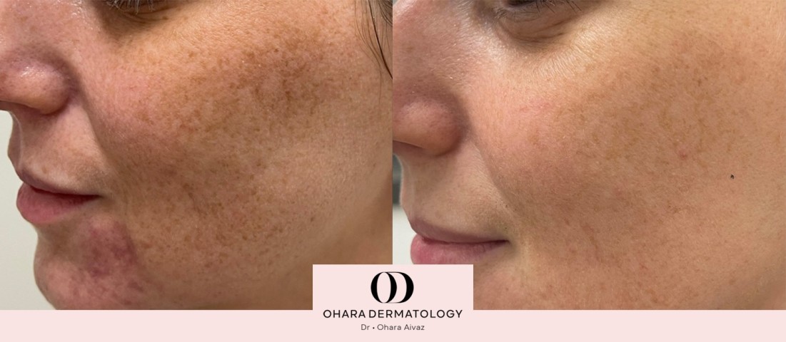 Pigmentation and freckle removal