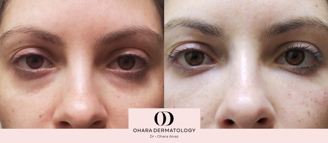 Before and After Under eye filler 1