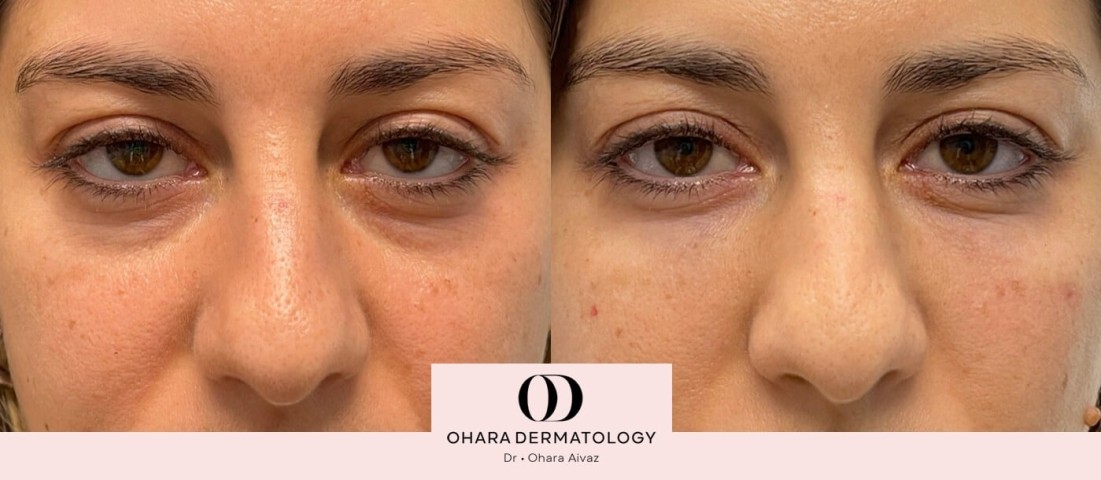 Before and After Under eye filler 2