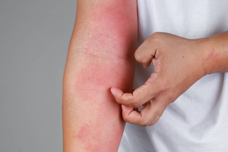 Featured image for Can Mold Trigger Eczema?