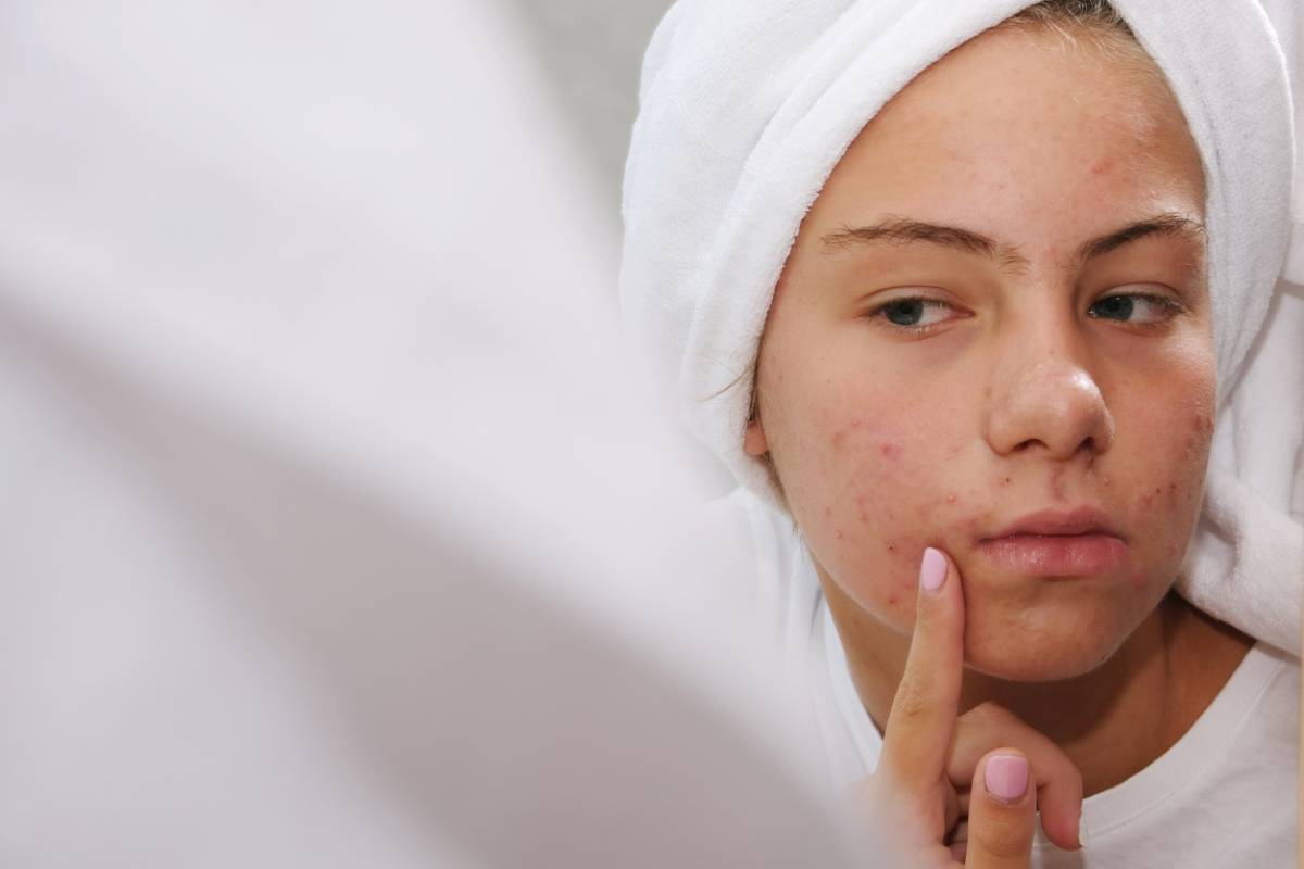 Featured image for Does Toothpaste Help Clear Acne?