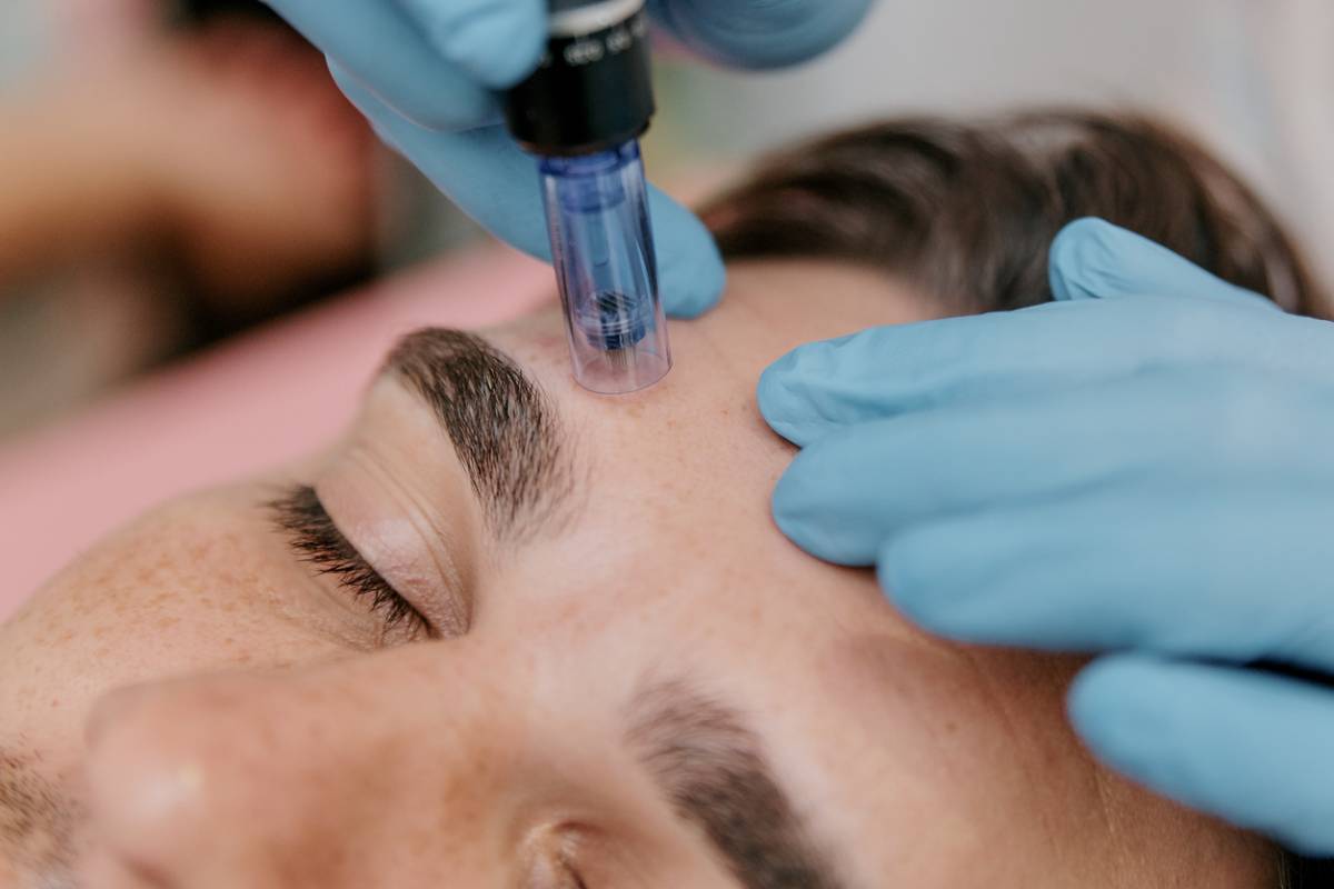Featured image for How Often Can You Microneedle Your Face
